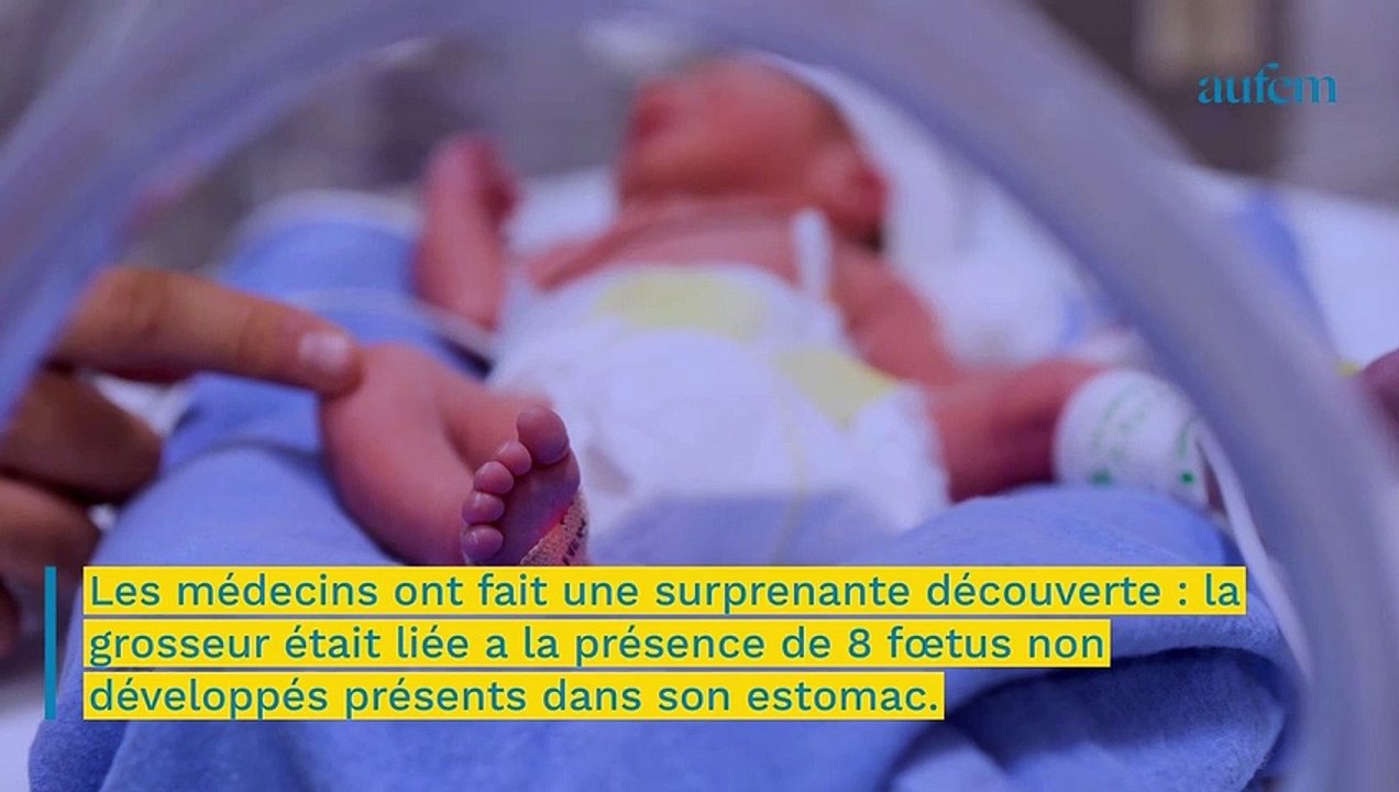 un-b-b-na-t-avec-huit-foetus-non-d-velopp-s-dans-son-estomac-vid-o