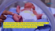 Un bébé naît avec huit foetus non développés dans son estomac