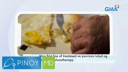 Ano nga ba ang lunas sa psoriasis? | Pinoy MD