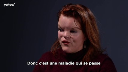 Clémence Bellanger, atteinte de malformations physiques : "J’ai des malformations, beaucoup au niveau du visage"