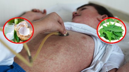 खसरा से कैसे करे बचाव, खसरा से बचने के उपाय | Boldsky *Health