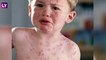 Measles outbreak in Mumbai: मुंबईत गोवरचा उद्रेक, रुग्णसंख्या शंभर पार! केंद्रीय आरोग्य मंत्रालयाकडून विशेष सूचना जारी