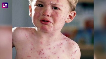 Measles outbreak in Mumbai: मुंबईत गोवरचा उद्रेक, रुग्णसंख्या शंभर पार! केंद्रीय आरोग्य मंत्रालयाकडून विशेष सूचना जारी