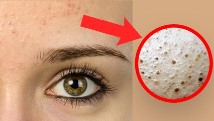 माथे के जिद्दी ब्लैकहेड्स से को जड़ से खत्म करेगा ये उपाय । Boldsky *Health