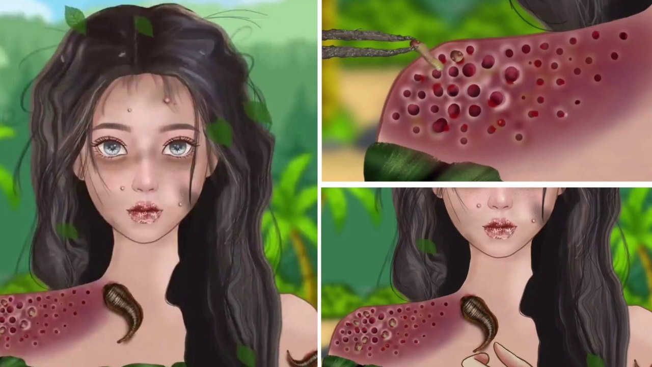 ASMR Treatment of infections caused by wearing facial piercings - 얼굴 피어싱 착용으로 인한 감염 치료