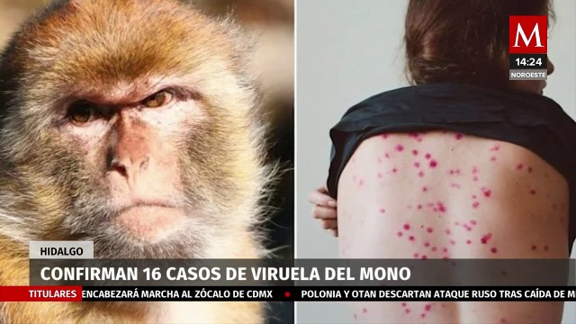 Casos de viruela del mono en Hidalgo suman 16 confirmados