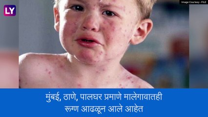 Measles In Maharashtra: सावधान! राज्यात गोवरचे थैमान, मालेगावमध्येही आढळले रुग्ण