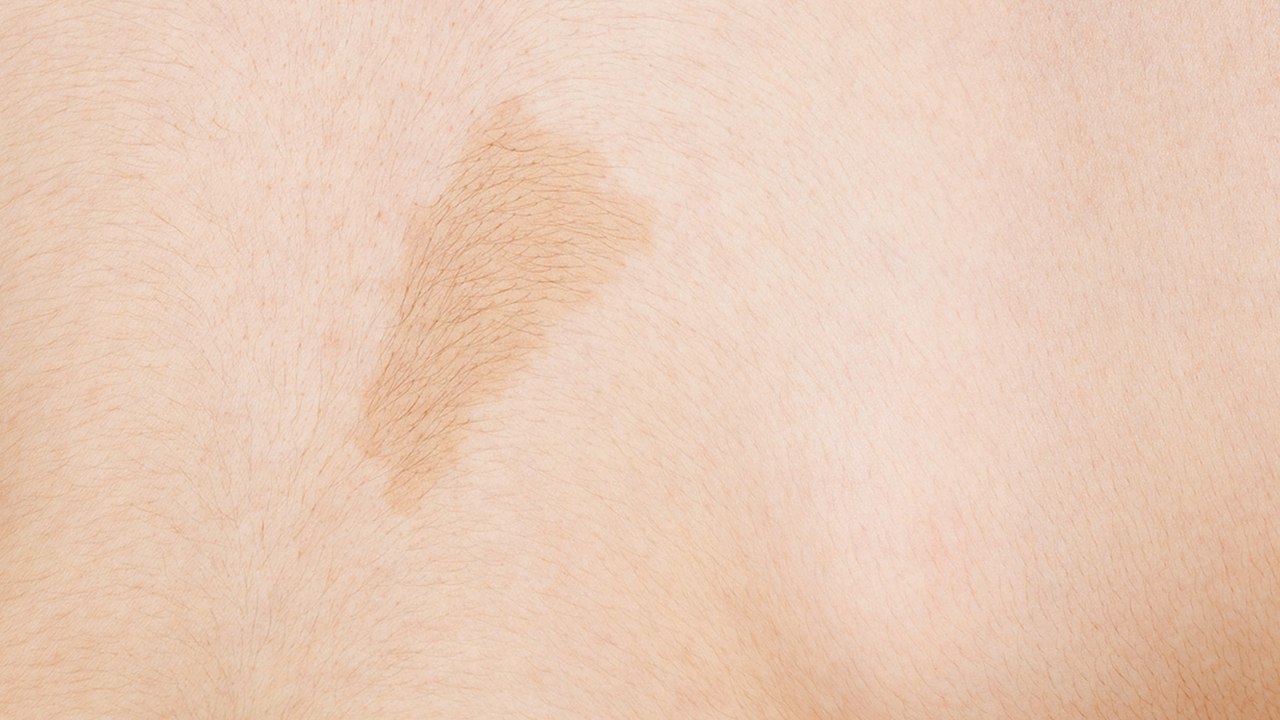 Café au lait Flecken beim Kind Das bedeuten die hellbraunen