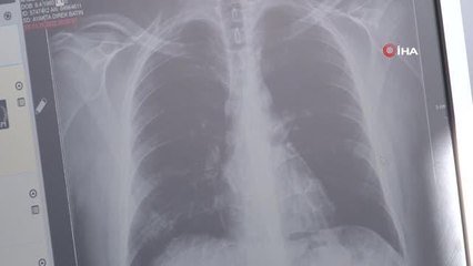 KOAH hastalarına 'sigara' uyarısı