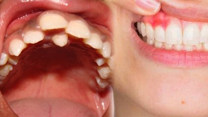 दांत के ऊपर दांत क्यों चढ़ते हैं, चौंका देगी वजह |Why do teeth climb on teeth, the reason |*Health