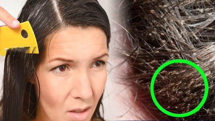 सिर में जूं होने के कारण | सिर में जुएं होने से क्या होता है | Boldsky *health