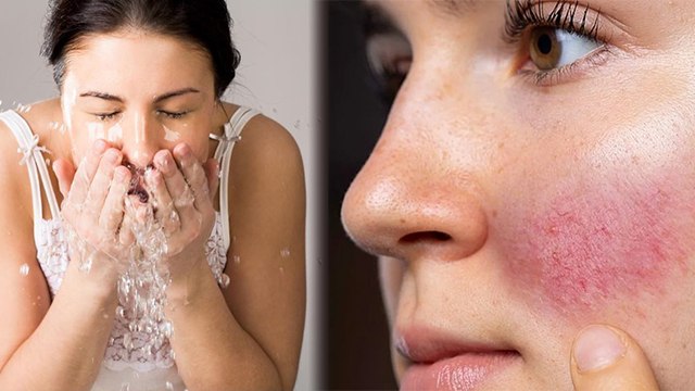 सर्दियों में गर्म पानी से चेहरा धोने से क्या होता है | गर्म पानी से चेहरा धोने के नुक़सान | Boldsky