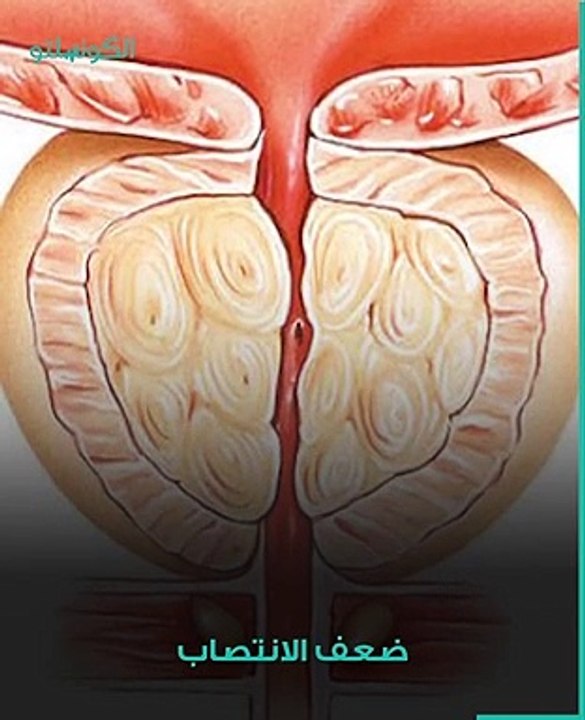 ما هو سرطان البروستاتا؟