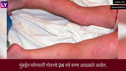 Measles Outbreak In Mumbai: मुंबईत आढळले गोवरचे 24 नवे रूग्ण, चिंता वाढली