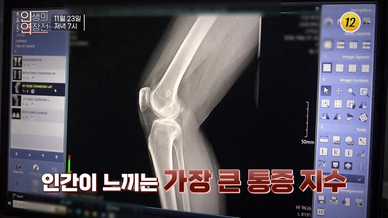 관절염을 극복해 인생의 연장전을 살아가는 그녀의 건강 비법!_인생의 연장전 18회 예...