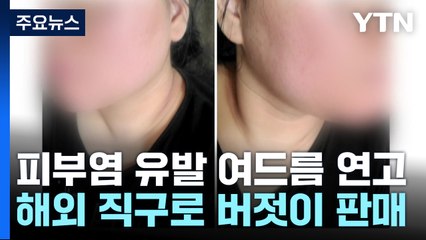 "피부염 유발" 여드름 연고 버젓이 판매...통관 사각지대 탓 / YTN
