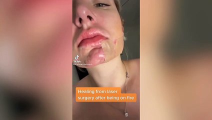 Sudbury burns victim continues miraculous recovery