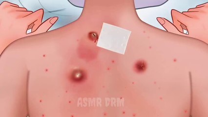 How to remove pimple | Back pimples remove  treatment | #ASMTDRM #Pimpleremove #animation