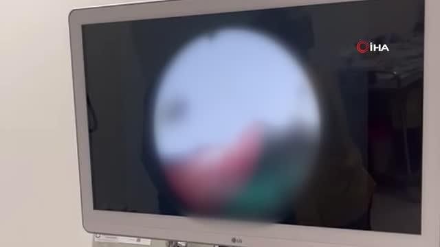 Ekmek yerken ölümden döndü: Ekmeğin içinden çıkan 2 buçuk santimlik tel boğazına yapıştı