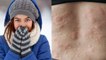 ऊनी कपड़े पहनने से क्यों होती है एलर्जी ,स्किन पर ऊनी कपड़े पहनने से एलर्जी का कारण |Boldsky *Health