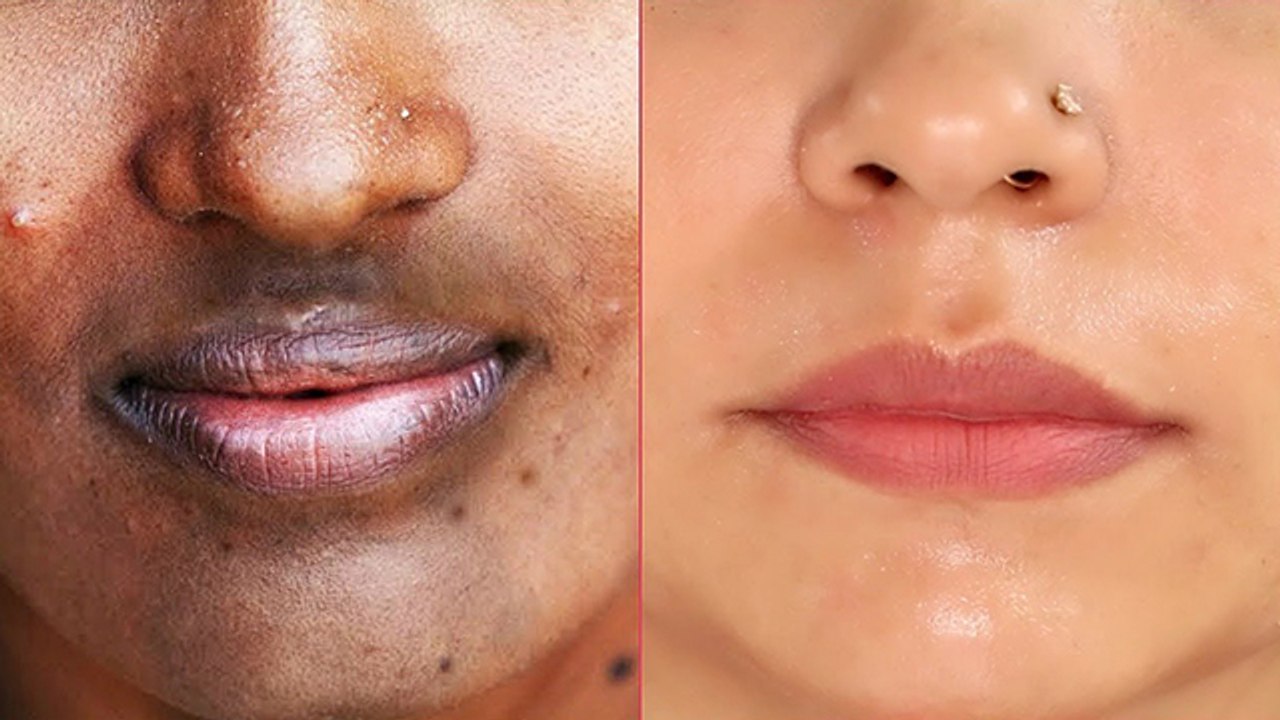 चीन का कालापन क्यों होता । चीन का कालापन दूर करने के उपाय । Boldsky *Health