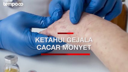 Mengetahui Gejala Cacar Monyet, Tidak Hanya Ruam