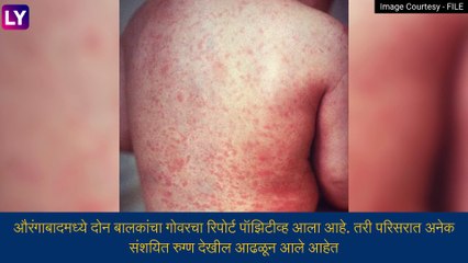 Aurangabad Measles: मुंबई पाठोपाठ औरंगाबादेत गोवरची एण्ट्री, दोन बालकांना गोवरची लागण