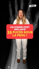 Un homme s'est implanté 35 puces sous la peau !