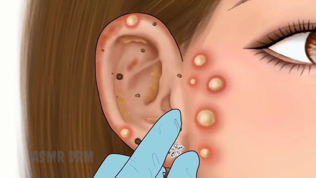 ASMR Pimple blackhead and sebaceous cyst removal for gamer | Massage ear - Tingle animation #ASMRDRM #removeearwax #eartreatment #asmr