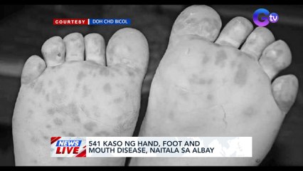 541 kaso ng Hand, Foot and Mouth Disease, naitala sa Albay | News Live