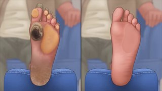 ASMR Treatment of severely hard and cracked feet | Calluses, Plantar Warts, Corn  animesh playing  satisfying video