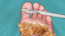 ASMR Remove Large Plantar Warts, Huge Navel Stone, Salivary Gland Stones, Ear Cleaning