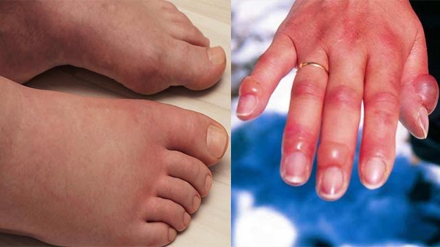 ठंड में हाथ पैरों में सूजन क्यों होती है । ठंड में हाथ पैरों में सूजन होने के कारण । Boldsky *Health