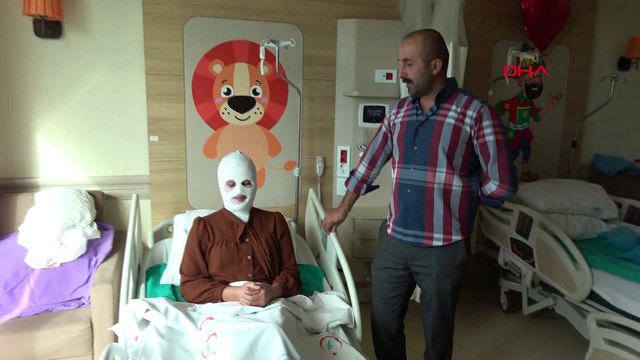 Düdüklü tencere genç kızın suratına patladı!