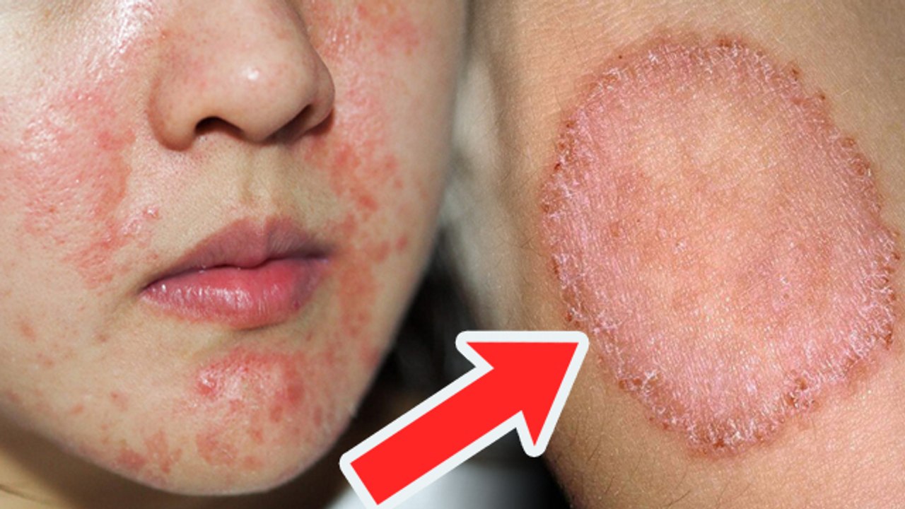 चर्म रोग क्यों होता है | चर्म रोग होने का कारण | Charm Rog Hone Ke Karan | Boldsky *health