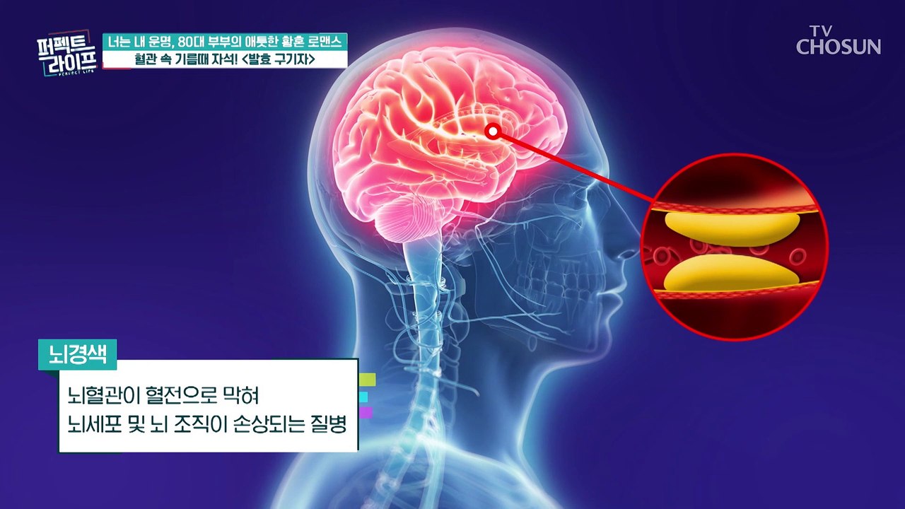35분마다 1명씩 사망자 발생?! 무서운 혈관질환 뇌졸중 TV CHOSUN 20221130 방송