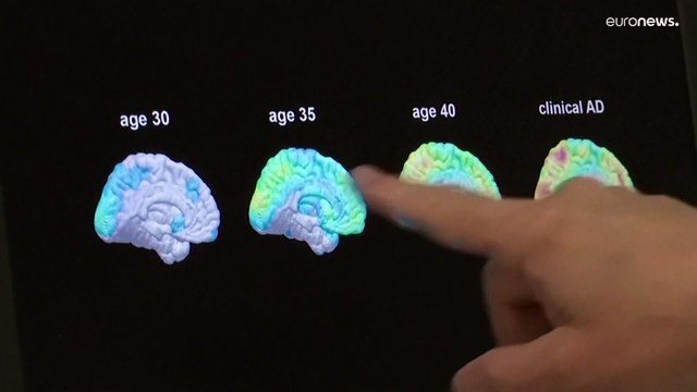 В США представлен новый препарат для замедления развития Альцгеймера