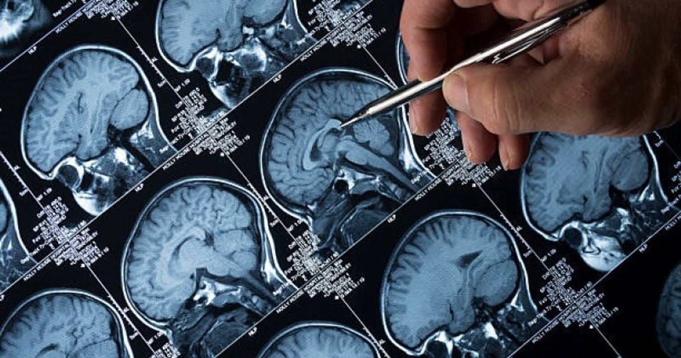 Des chercheurs trouvent un potentiel traitement contre la maladie d'Alzheimer, un espoir pour la recherche