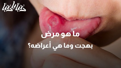 ما أعراض مرض بهجت؟