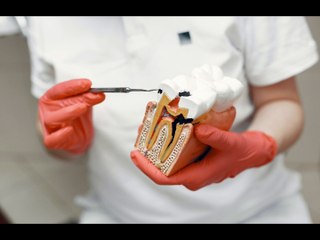 Sellador de fosetas y fisuras