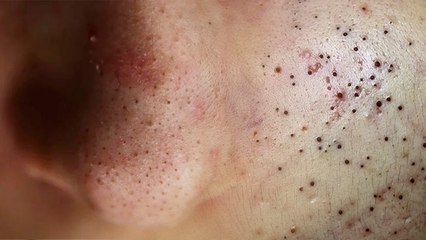 चेहरे पर ब्लैकहेड्स क्यों होते हैं, चेहरे पर Blackheads  होने का कारण क्या है | Boldsky *Health