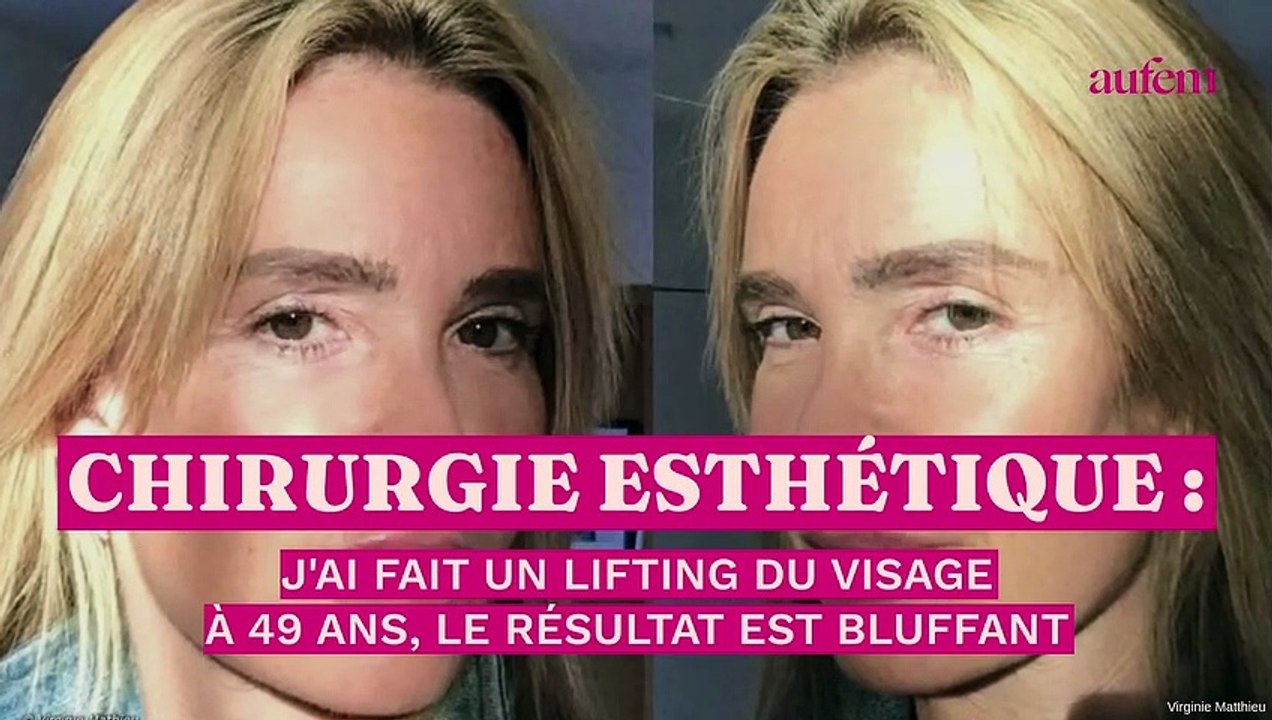 Chirurgie esthétique : j’ai fait un lifting du visage à 49 ans, le résultat est bluffant