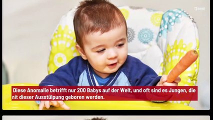 Mexiko: Ein Baby wird mit einem Schwanz geboren