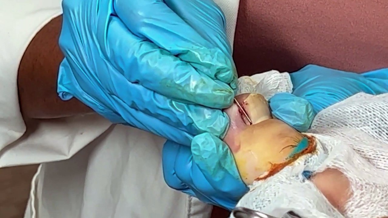Houston Foot Doctor Treats Ingrown Nail #ingrowntoenailremoval #podiatrist #footdoctor