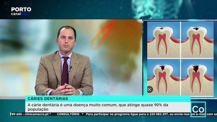 Consultório - A cárie dentária é uma doença muito comum, que atinge quase 90% da população