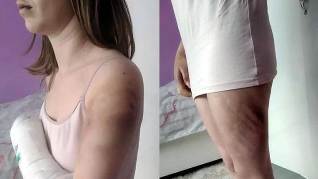 Kız arkadaşını beyzbol sopasıyla döven caniye ertelemesiz 10 ay hapis