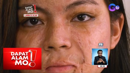 ‘Beautiful scars’: Ang kuwento sa likod ng pagkakalapnos ni Larra | Dapat Alam Mo!
