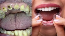 दांतों से जुड़ी बीमारी Bruxism क्या है | Bruxism Treatment & Bruxism Symptoms | Boldsky *Health
