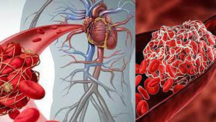 नसों में खून का थक्का जमने पर क्या होता है | Blood Clot Symptoms | Boldsky *Health