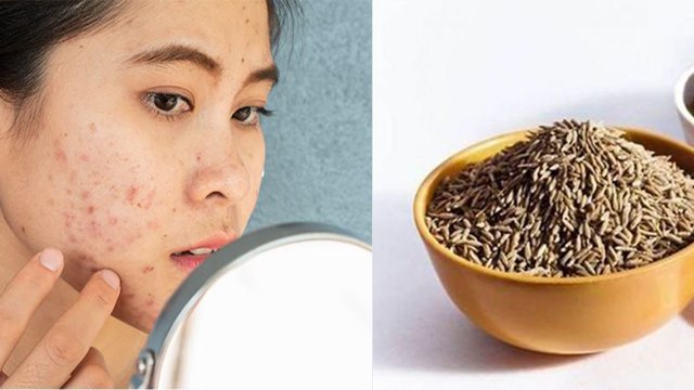 Pimples पर जीरा पाउडर लगाने से क्या होता है | चेहरे के कील मुंहासे कैसे दूर करें | Boldsky *health